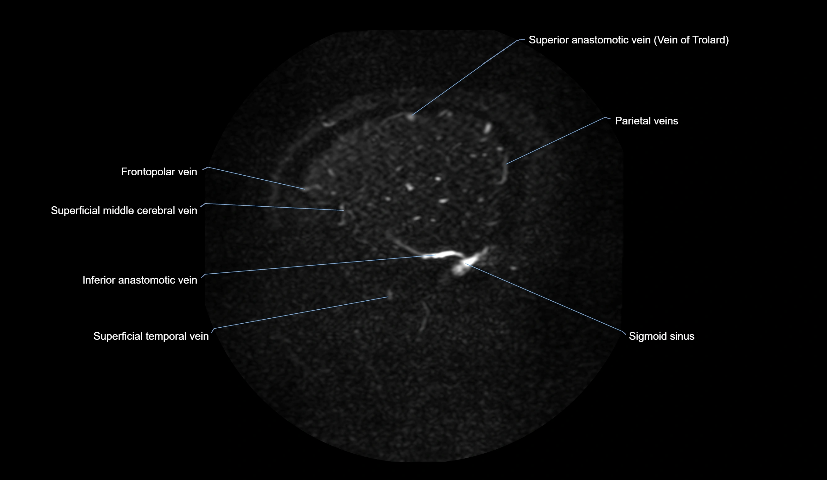 MRV brain sagittal anatomy 3T MRI images -img-01015-00070.webp